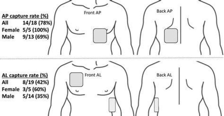 Where should aed pads be placed anterolateral?