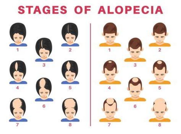 Which alopecia is permanent?