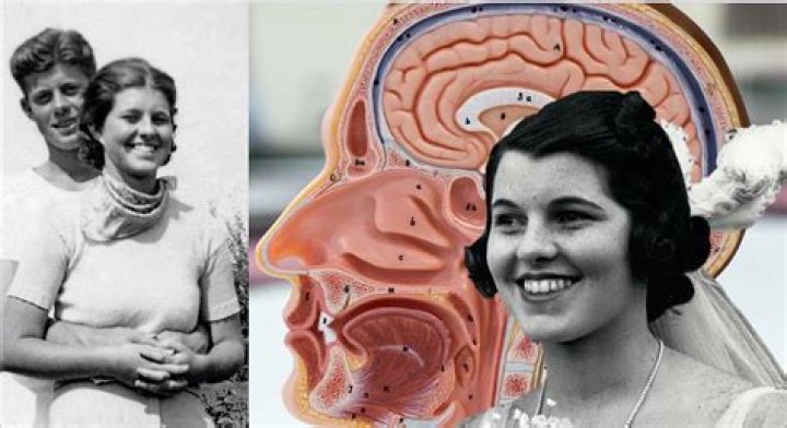 Which kennedy had a lobotomy?