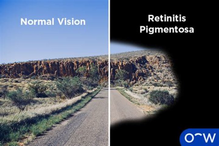 Who does retinitis pigmentosa affect?