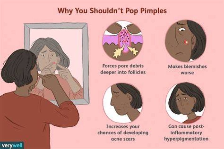 Why can't i stop squeezing pimples?