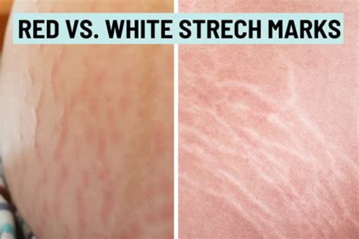 Why do i still have stretch marks?