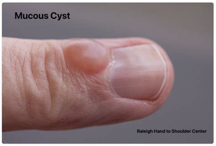 Why do mucous cysts form?