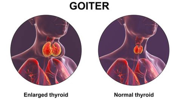 Why does goitre occur?