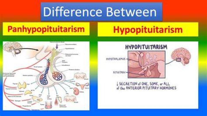 Why does hypopituitarism occur?