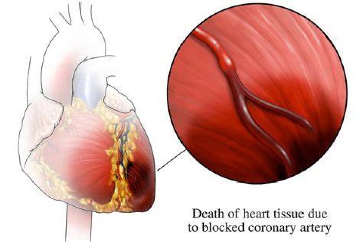 Why is ischemia painful?