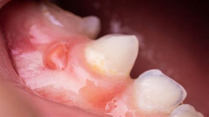 Why is my gum bubbled up?
