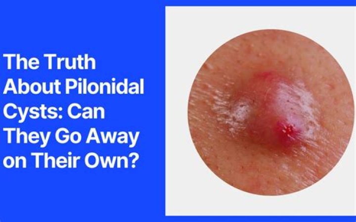 Why pilonidal cyst happen?