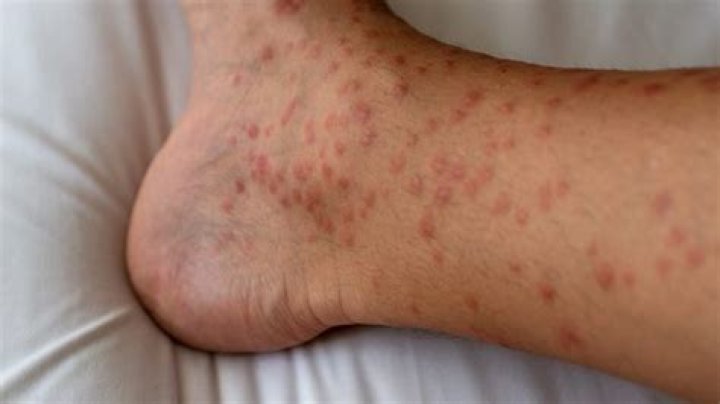 Will cholinergic urticaria go away?