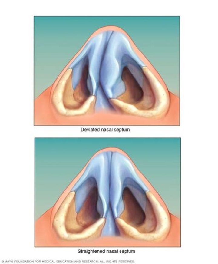 Will deviated septum heal itself?