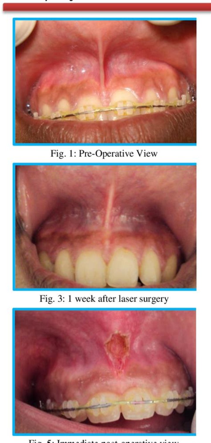 Will labial frenulum grow back?