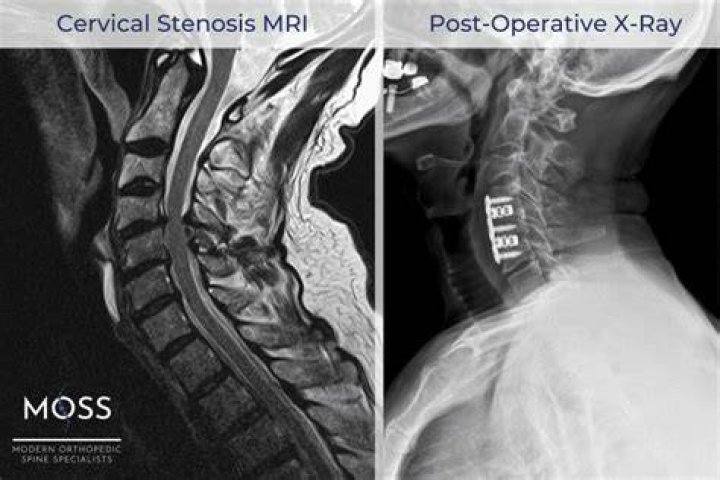 Will steroids help degenerative myelopathy?