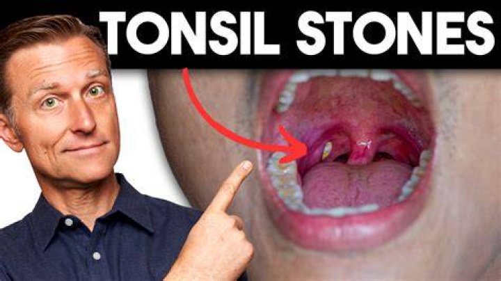 Will they remove tonsils for tonsil stones?