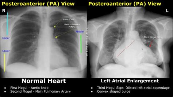 Would a chest xray show heart problems?
