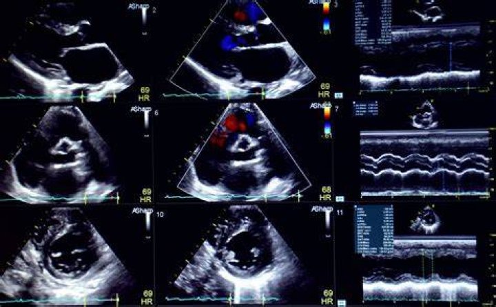 Would an echocardiogram show blockages?
